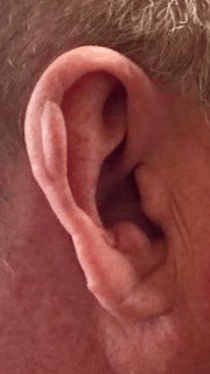 Keloid before and after