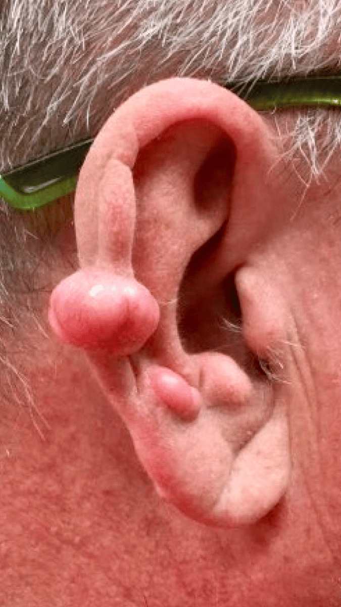 Keloid before and after