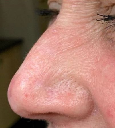 Squamous cell cancer before and after