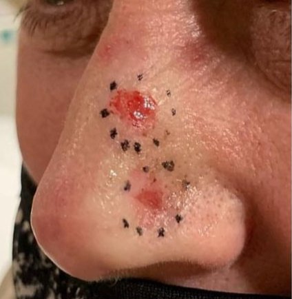 Squamous cell cancer before and after