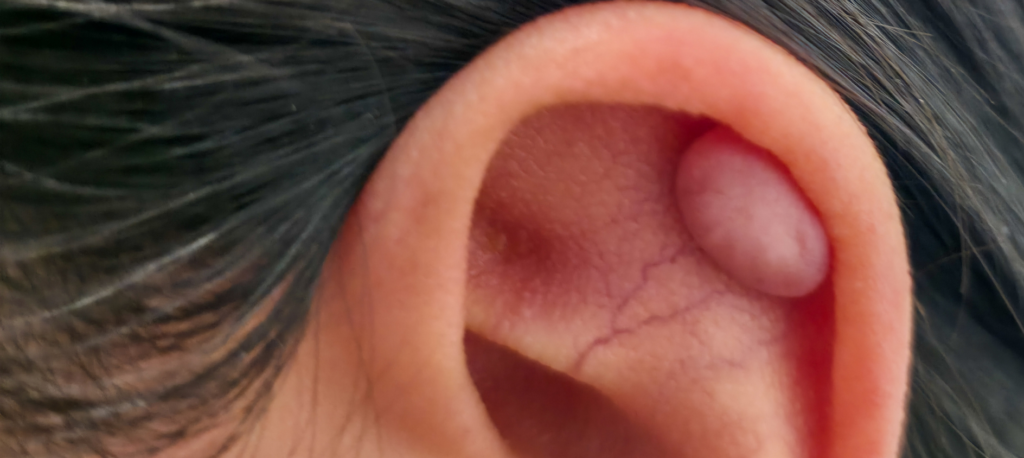 Keloids Treatment: What Options Are Available?